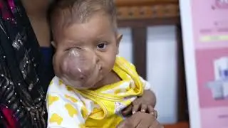Unbelievable Face Tumor for a 1 Year Baby