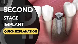 What is a Second Stage Implant Procedure? Quickly Explained in a Few Seconds!