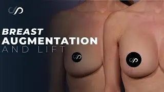 BEAUTIFUL Breast Augmentation after a Lift!