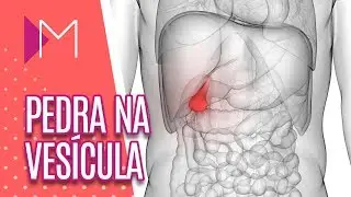Pedra na vesícula - Mulheres (24/01/2019)