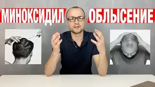 Облысение у мужчин. Лечение / Миноксидил для бороды и волос / Из за чего выпадают волосы