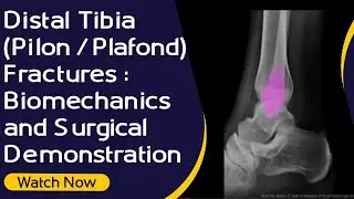 Distal Tibia (Pilon / Plafond ) Fractures : Biomechanics and Surgical Demonstration