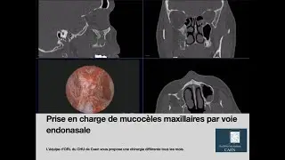 Chirurgie endonasale: prise en charge de mucocèles maxillaires