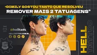 Resultado de apenas 1 sessão no @Dimiily  |  Remoção de Tatuagem