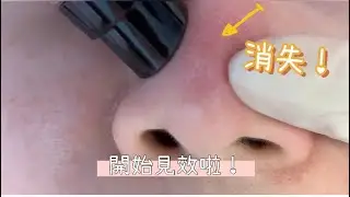 獨家Aqua Peel 包配美國奇蹟水✨