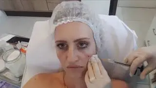 TUDO SOBRE MEU PREENCHIMENTO ABAIXO DOS OLHOS