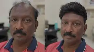 Topee Client Transformations | Baldness Solution | Before & After