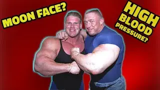 Steroids and High Blood Pressure! Telmisartan Doesn't Work? Moon Face, Bloating and Water Retention.