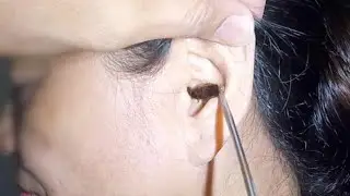 Woman's HUGE Cockroach Stuck in Her Ear Removed