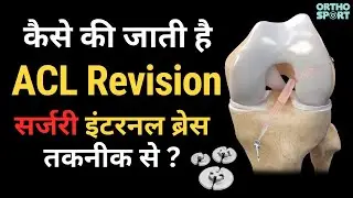 कैसे की जाती है ACL Revision सर्जरी इंटरनल ब्रेस तकनीक से ? 