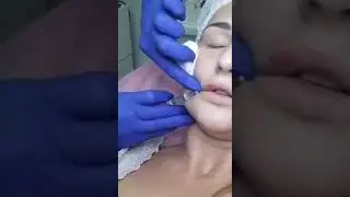 Коррекция губ филером в клинике Аура