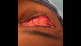Eyelid Surgery Atlanta GA | Blepharoplasty