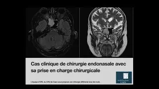 Cas clinique chirurgie endonasale.