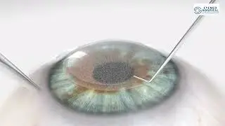 Experience the Power of ZEISS VisuMax® 800 – SMILE Pro at Eyemed Hospital, Coimbatore.
