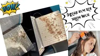Lice Comb - উকুনের চিরুনি | লাইস রিমুভার, Lice comb price in Bangladesh