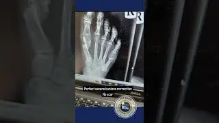Dr. Kevin Lam's No-Scar Bunion Correction Revolution | Minimally Invasive Surgery