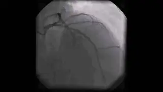 Myocardial bridge