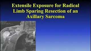 Extensile Exposure for a Radical Limb Sparing Resection of an Axillary Sarcoma