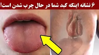۶ نشانه اینکه کبد شما در حال چرب شدن است!
