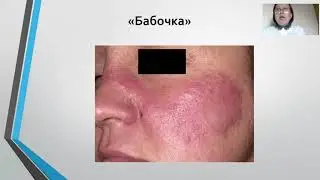 Системные заболевания соединительной ткани, лекция для студентов 5 курса