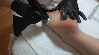 Foot Callus Removal ASMR by a 20-Year Skin Care Expert