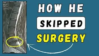 Lumbar Disc Extrusion recovered and skipped surgery