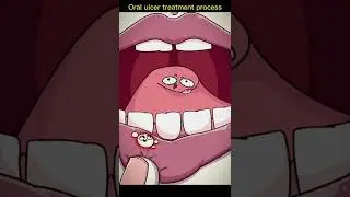 Oral ulcer treatment process