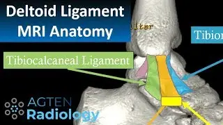 MRI Anatomy of Ankle Ligaments: Deltoid Ligament