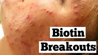 Biotin for Acne Breakouts? | Acne Supplements | Clear Skin Tips | Hair, Skin, Nails Vitamins