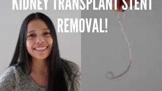 Kidney stent removal