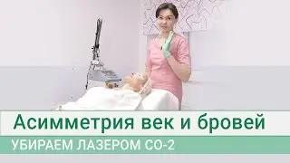 Asymmetry of the eyelids and eyebrows: We remove it with a CO2 laser