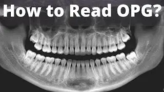 How to read Dental #orthopantomogram (OPG) Anatomical Landmarks, Indication || Oral radiology