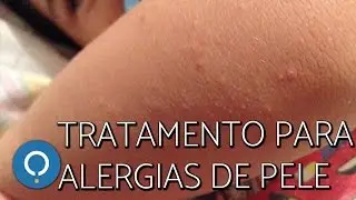 Tratamento natural para ALERGIAS DA PELE