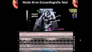 Ecocardiografía fetal: Ultrasonido en Modo M para Evaluar el corazón fetal