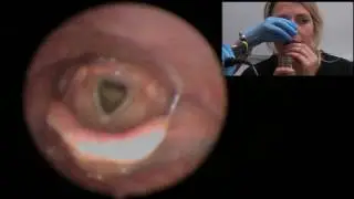 What happens when you have a fibre-optic endoscopic evaluation ofswallowing