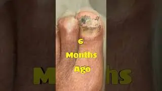 Fungal Toenails Can Be Cured 