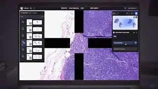AI + Humanity vs. Cancer: We're about to win.#ai