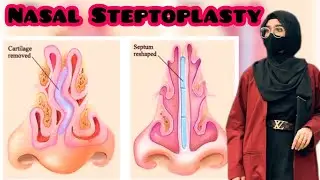 Nasal Steptoplasty (Surgery)❗