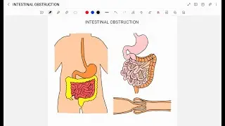 INTESTINAL OBSTRUCTION