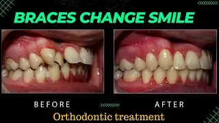 🫵Does braces change your smile??? your dentist | Orthodontic treatment braces before & after #braces