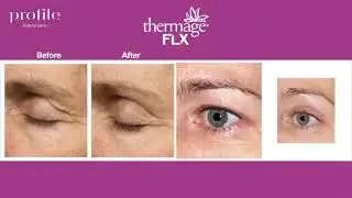 Profile Beauty - Thermage Promotion Video 3 Before and After