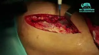 Fractura de cadera