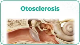 Otosclerosis 👂 : ENT Lectures