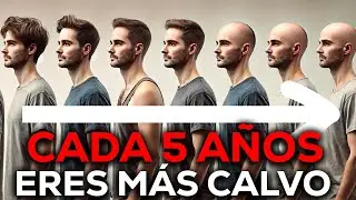 Cada 5 AÑOS tu ALOPECIA EMPEORA 1 GRADO : COMPRUEBA TUS GENES