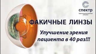 Факичные линзы. Улучшение зрения сразу после операции.