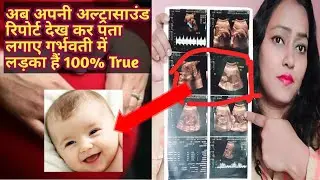 Placenta position | Baby gender prediction from placenta location anterior or posterior in pregnancy