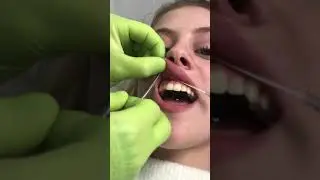 Smiley piercing