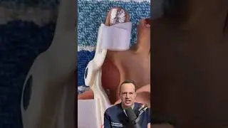 AMAZING FAILURE TO FIX A BUNION! 😱 