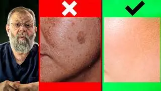 Age spots WILL GO FAST thanks to THIS simple method!