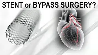 Stent or Bypass Surgery?